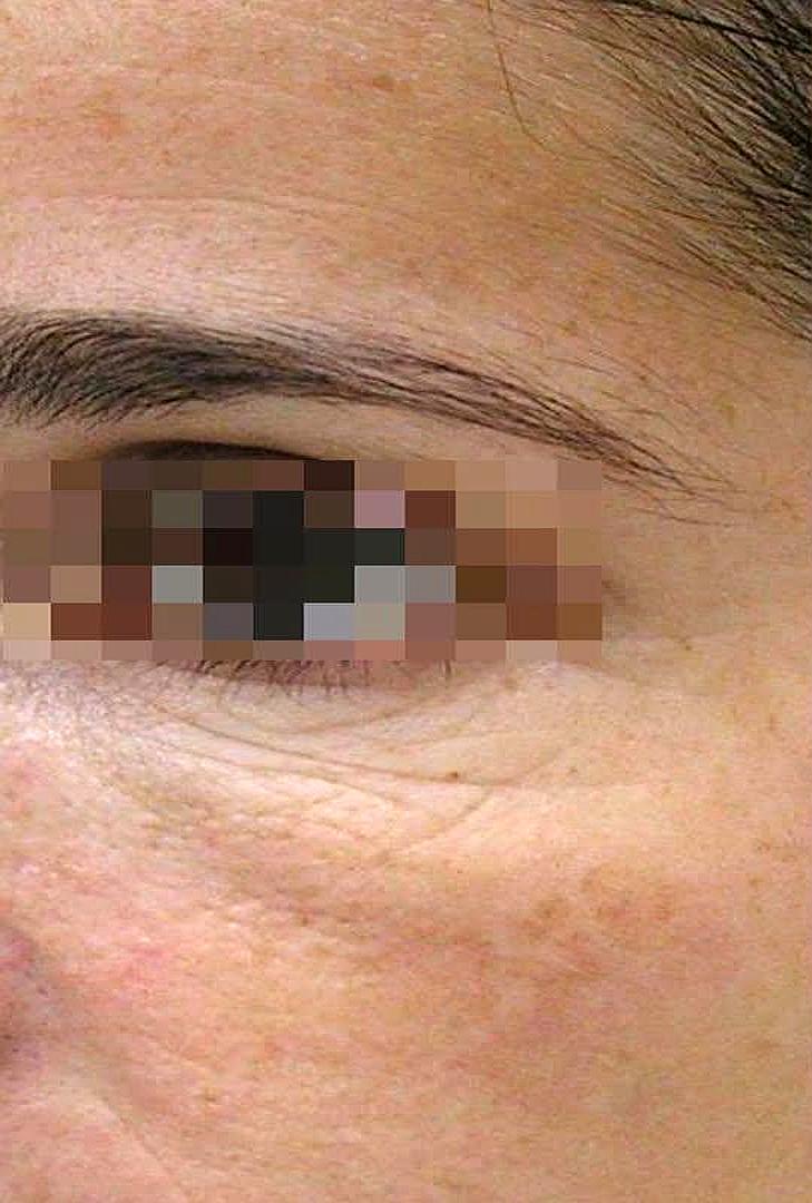 Avant masque collagène PDRN ExoBlanc — ridules contour des yeux