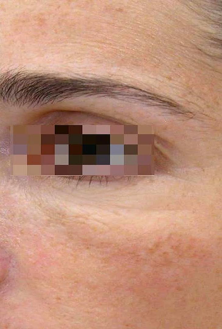 Après masque collagène PDRN ExoBlanc — contour des yeux densifié ridules atténuées