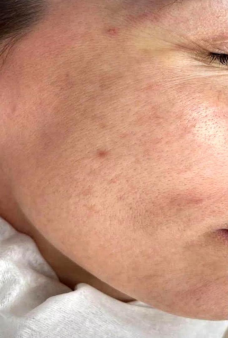 Avant masque anti-âge ExoBlanc — grain de peau irrégulier teint terne