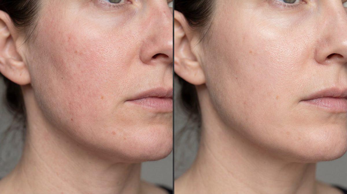 Antes/después de ExoBlanc: piel apagada vs piel luminosa y densificada después de un tratamiento de colágeno